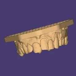 3D Model of Dental Veneers - Upper and Lower Arches (14-25 / 35-45)