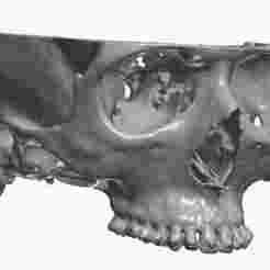 CBCT cranium + teeth