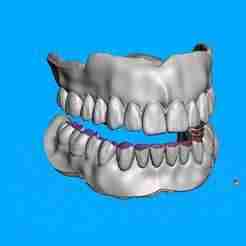 (training) dentures-teeth-and-bases