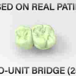Two-Unit Dental Bridge - Teeth 25,26